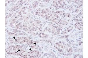 IHC-P Image Immunohistochemical analysis of paraffin-embedded A549 xenograft, using NSD2, antibody at 1:100 dilution. (WHSC1 antibody  (N-Term))