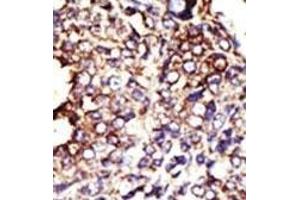 Formalin-fixed and paraffin-embedded human cancer tissue reacted with the primary antibody, which was peroxidase-conjugated to the secondary antibody, followed by DAB staining. (GCNT1 antibody  (AA 88-117))