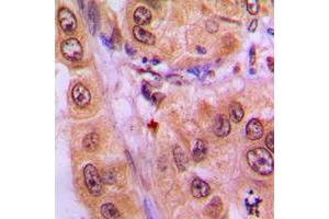 Immunohistochemical analysis of STAT3 (pY705) staining in human lung cancer formalin fixed paraffin embedded tissue section. (STAT3 antibody  (C-Term, pTyr705))