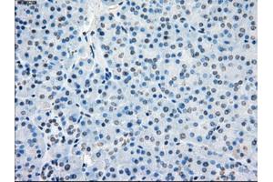 Immunohistochemical staining of paraffin-embedded Adenocarcinoma of colon tissue using anti-BUB1Bmouse monoclonal antibody. (BUB1B antibody)