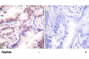 Immunohistochemistry analysis of paraffin-embedded human lung carcinoma tissue using RBBP8 polyclonal antibody . (Retinoblastoma Binding Protein 8 antibody)