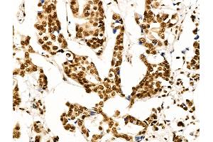 ABIN7094736 and ABIN7098787 at 1/100 staining Human breast cancer by IHC-P. (OVOL2 antibody  (Internal Region))