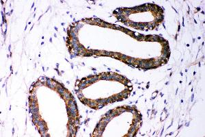Anti- Dicer antibody, IHC(P) IHC(P): Human Mammary Cancer Tissue (DICER1 antibody  (AA 1-195))