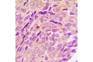 Immunohistochemical analysis of Cytochrome P450 2U1 staining in human breast cancer formalin fixed paraffin embedded tissue section. (CYP2U1 antibody  (Center))