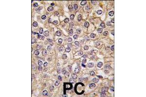 Formalin-fixed and paraffin-embedded human prostata carcinoma tissue reacted with, which was peroxidase-conjugated to the secondary antibody, followed by DAB staining. (IL1A antibody  (C-Term))