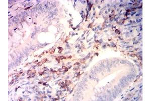 Immunohistochemical analysis of paraffin-embedded rectum cancer tissues using CD14 mouse mAb with DAB staining. (CD14 antibody  (AA 230-345))