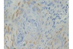 IHC-P analysis of Human Skin cancer Tissue, with DAB staining.