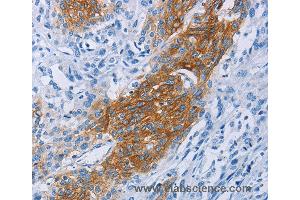 Immunohistochemistry of Human thyroid cancer using CCR9 Polyclonal Antibody at dilution of 1:60 (CCR9 antibody)