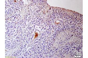 Formalin-fixed and paraffin embedded human glioma tissue labeled with Anti IGFR3/CD16 Polyclonal Antibody, Unconjugated (ABIN761381) at 1:200 followed by conjugation to the secondary antibody and DAB staining (CD16a, CD16b (AA 131-230) antibody)