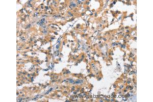 Immunohistochemistry of Human cervical cancer using SCARB1 Polyclonal Antibody at dilution of 1:60 (SCARB1 antibody)