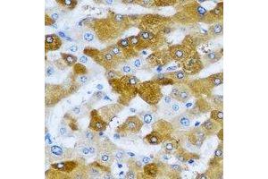 Immunohistochemical analysis of HAGH staining in human liver cancer formalin fixed paraffin embedded tissue section.