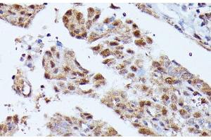 Immunohistochemistry of paraffin-embedded Human thyroid cancer using KIAA1429 Polyclonal Antibody at dilution of 1:100 (40x lens).