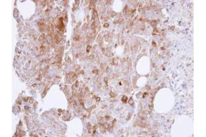 IHC-P Image Immunohistochemical analysis of paraffin-embedded ES-2 xenograft , using UAP1, antibody at 1:500 dilution. (UAP1 antibody)