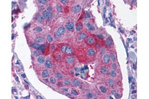 Anti-CCKBR / Cckb antibody IHC of human Breast, Carcinoma. (CCKBR antibody  (Extracellular Domain))