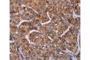 Immunohistochemistry of Human gastric cancer using HSPE1 Polyclonal Antibody at dilution of 1:40 (HSPE1 antibody)