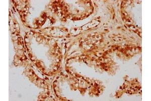 IHC image of ABIN7147479 diluted at 1:300 and staining in paraffin-embedded human prostate cancer performed on a Leica BondTM system. (GLTPD1 antibody  (AA 1-214))