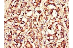Immunohistochemistry of paraffin-embedded human gastric cancer using ABIN7158350 at dilution of 1:100 (LASP1 antibody  (AA 128-252))