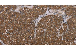 Immunohistochemistry of paraffin-embedded Human ovarian cancer tissue using FOLH1B Polyclonal Antibody at dilution 1:30 (FOLH1B antibody)