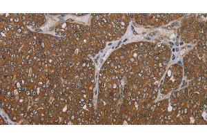 Immunohistochemistry of paraffin-embedded Human ovarian cancer tissue using FOLH1B Polyclonal Antibody at dilution 1:30