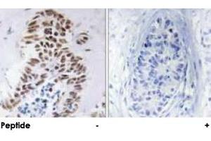 Immunohistochemical analysis of paraffin-embedded human lung carcinoma tissue using DAPK3 polyclonal antibody .