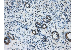 Immunohistochemical staining of paraffin-embedded Adenocarcinoma of breast tissue using anti-DCXR mouse monoclonal antibody. (DCXR antibody)