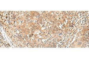 Immunohistochemistry of paraffin-embedded Human cervical cancer tissue using KCNA10 Polyclonal Antibody at dilution of 1:40(x200) (KCNA10 antibody)