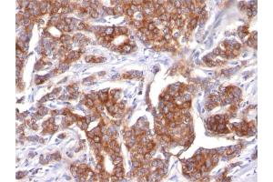Formalin-fixed, paraffin-embedded human Breast Carcinoma stained with Cytokeratin 18 Mouse Monoclonal Antibody (KRT18/834). (Cytokeratin 18 antibody)