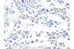 Immunohistochemistry of paraffin-embedded human lung cancer using MTA2 Antibody (ABIN4904441) at dilution of 1:100 (40x lens). (MTA2 antibody)