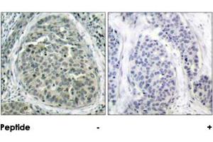 Immunohistochemical analysis of paraffin-embedded human breast carcinoma tissue, using CTNNB1 (phospho S37) polyclonal antibody . (CTNNB1 antibody  (pSer37))
