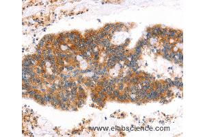 Immunohistochemistry of Human lung cancer using MLLT4 Polyclonal Antibody at dilution of 1:40 (Afadin antibody)