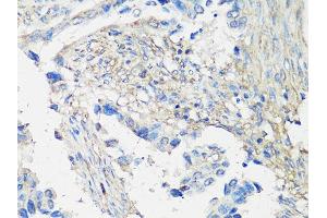 Immunohistochemistry of paraffin-embedded human lung cancer using MMP2 Antibody (ABIN5998246) at dilution of 1/100 (40x lens). (MMP2 antibody)