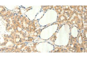 Immunohistochemistry of paraffin-embedded Human thyroid cancer using TRPM5 Polyclonal Antibody at dilution of 1:60 (TRPM5 antibody)