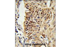 CIRBP Antibody IHC analysis in formalin fixed and paraffin embedded human lung carcinoma followed by peroxidase conjugation of the secondary antibody and DAB staining. (CIRBP antibody  (C-Term))