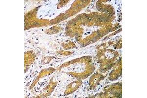 Immunohistochemical analysis of p53 staining in human colon cancer formalin fixed paraffin embedded tissue section. (p53 antibody  (N-Term))