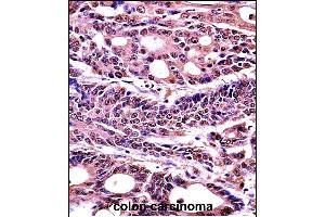 HMGB1 Antibody (C-term) (Ascites) (ABIN1536601)immunohistochemistry analysis in formalin fixed and paraffin embedded human colon carcinoma followed by peroxidase conjμgation of the secondary antibody and DAB staining. (HMGB1 antibody  (C-Term))