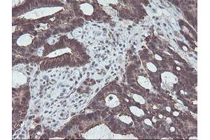Immunohistochemical staining of paraffin-embedded Adenocarcinoma of Human colon tissue using anti-CBR3 mouse monoclonal antibody. (CBR3 antibody)