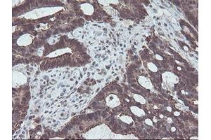 Immunohistochemical staining of paraffin-embedded Adenocarcinoma of Human colon tissue using anti-CBR3 mouse monoclonal antibody.