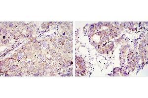 Immunohistochemical analysis of paraffin-embedded lung cancer (left) and colon tumour tissues (right) using IGC2BP3 mouse mAb with DAB staining. (IGF2BP3 antibody)