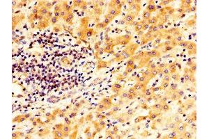 IHC image of ABIN7166409 diluted at 1:400 and staining in paraffin-embedded human liver cancer performed on a Leica BondTM system. (Transglutaminase 2 antibody  (AA 4-544))
