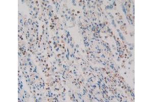Used in DAB staining on fromalin fixed paraffin- embedded lung cancer tissue (HMGXB4 antibody  (AA 264-540))
