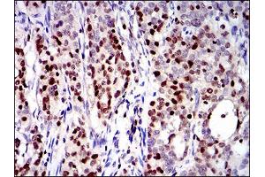 Immunohistochemical analysis of paraffin-embedded cervical cancer tissues using RUNX3 mouse mAb with DAB staining. (RUNX3 antibody  (AA 186-252))