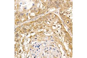 Immunohistochemistry of paraffin-embedded human lung cancer using UBB Rabbit pAb (ABIN6130181, ABIN6149775, ABIN6149776 and ABIN6222958) at dilution of 1:200 (40x lens). (UBASH3B antibody  (AA 1-300))