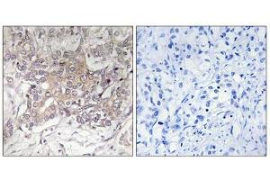Immunohistochemistry analysis of paraffin-embedded human liver carcinoma tissue using GCNT3 antibody.