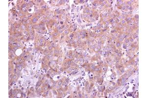 IHC-P Image TRAF5 antibody [N1N3] detects TRAF5 protein at cytoplasm on human breast carcinoma by immunohistochemical analysis.