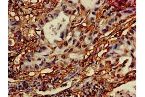 Immunohistochemistry of paraffin-embedded human lung cancer using ABIN7150140 at dilution of 1:100 (DRAM antibody  (AA 50-100))