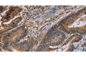 Immunohistochemistry of paraffin-embedded Human colon cancer tissue using FAM107A Polyclonal Antibody at dilution 1:30