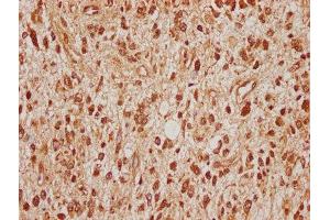 IHC image of ABIN7170677 diluted at 1:100 and staining in paraffin-embedded human glioma cancer performed on a Leica BondTM system. (SRPK2 antibody  (AA 471-688))