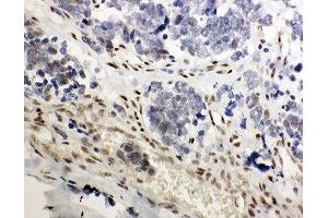 IHC-P: GR antibody testing of human lung cancer tissue (GR (AA 20-199) antibody)