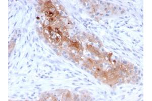 Formalin-fixed, paraffin-embedded human Bladder Carcinoma stained with Desmoglein-1 Mouse Monoclonal Antibody (32-2B).