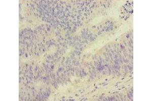 Immunohistochemistry of paraffin-embedded human colon cancer using ABIN7152525 at dilution of 1:100 (FOXRED1 antibody  (AA 307-486))